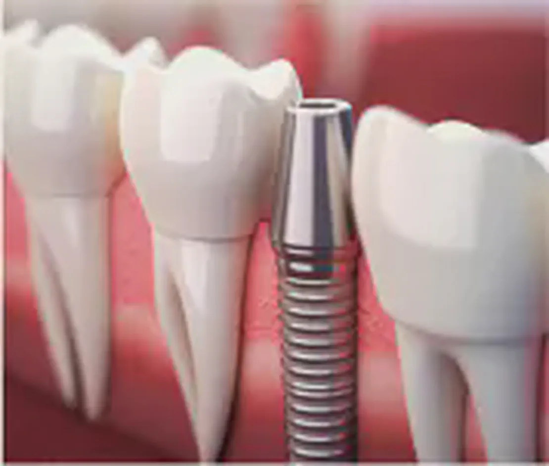 dental implants