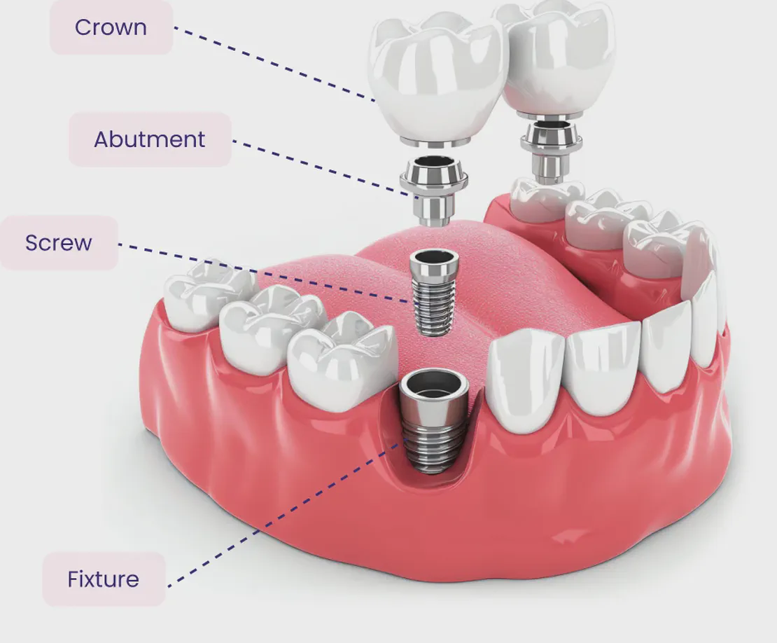Dental implants