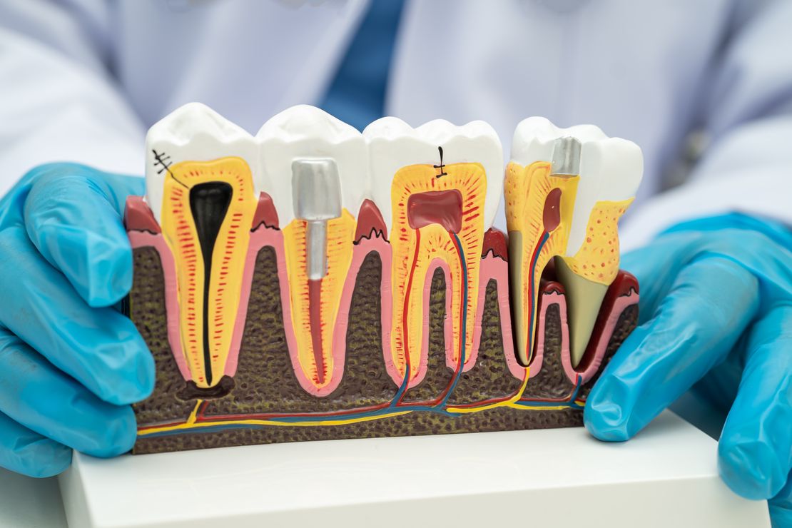 teeth whitening